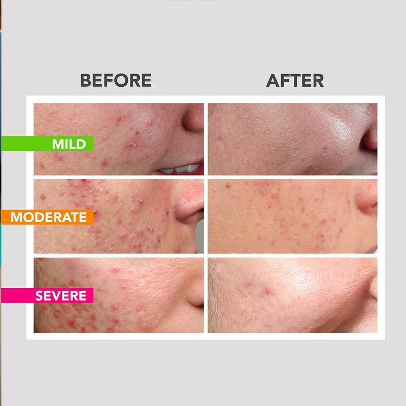 Acne Wipeout Clinical Acne System - Skincare Treatment for Gentle Skin Repair Acne Removal Three-Step Acne Acne Treatment Benzoyl Peroxide